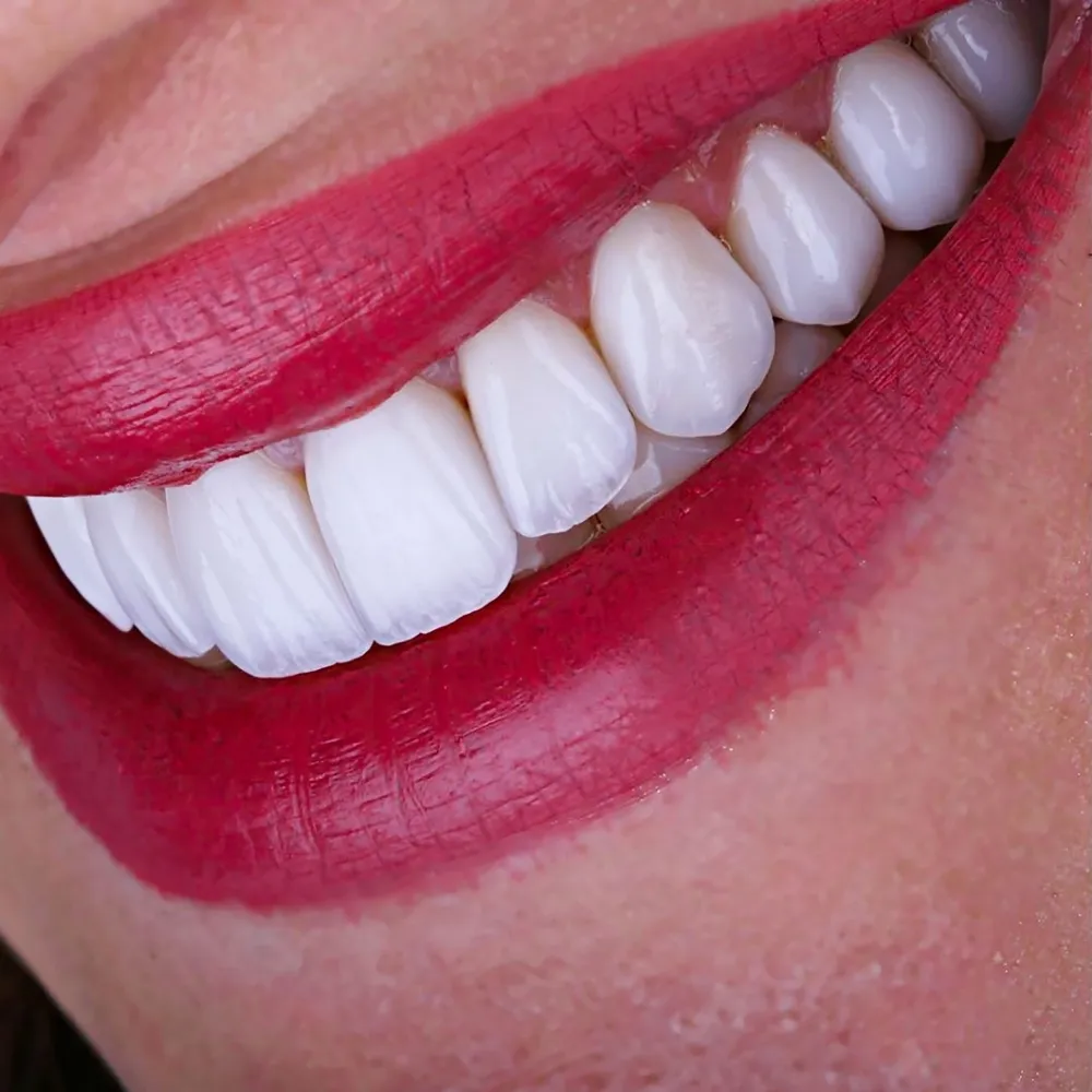 E-MAX VENEERS
